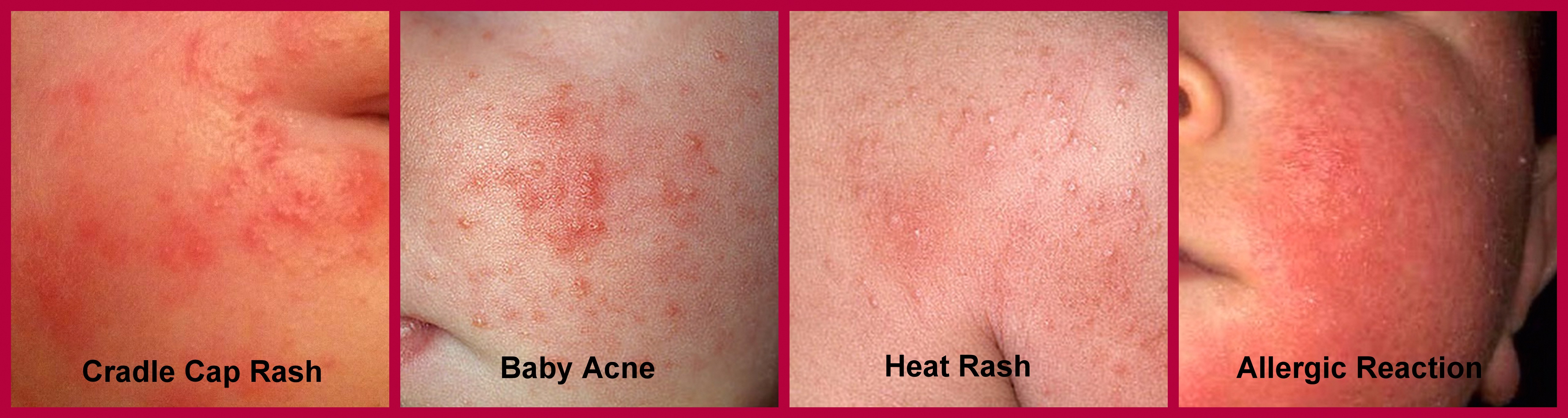 heat rash on babies face